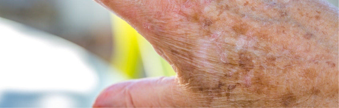 elderly person’s hand covered with age spots
