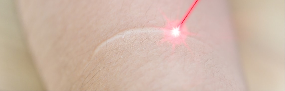 up close of laser beam treating white scar