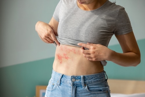 Woman with shingles on the skin she feels very painful