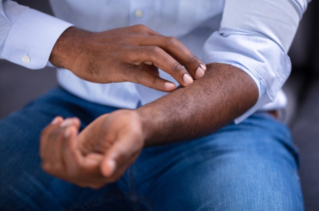 Professional African-American man scratching his hand due to a psoriasis flare up in Jacksonville Beach, FL