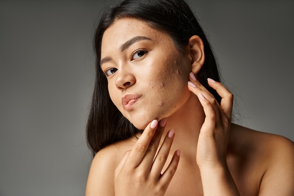 Adult woman with acne breakout on face