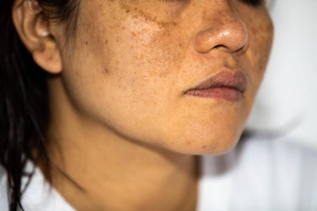 Close-up of young woman's face showing discoloration from melasma