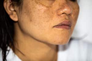 Close-up of young woman's face showing discoloration from melasma