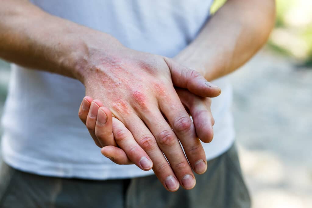 Person holding irritated, red, scaly skin on the back of one hand from psoriasis