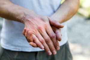 Person holding irritated, red, scaly skin on the back of one hand from psoriasis