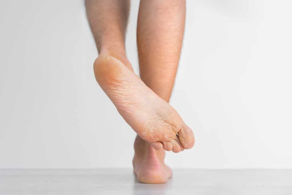 Bottom of a person’s foot showing peeling, cracked skin that may be a symptom of Athlete’s Foot