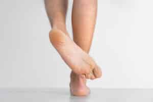Bottom of a person’s foot showing peeling, cracked skin that may be a symptom of Athlete’s Foot