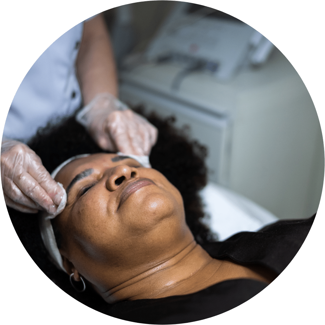 Chemical Peel