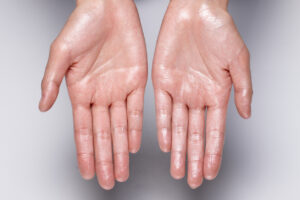 Person with sweaty hands due to hyperhidrosis